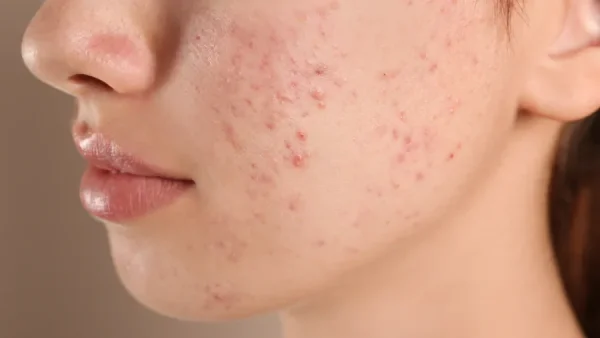 Pimple Purge